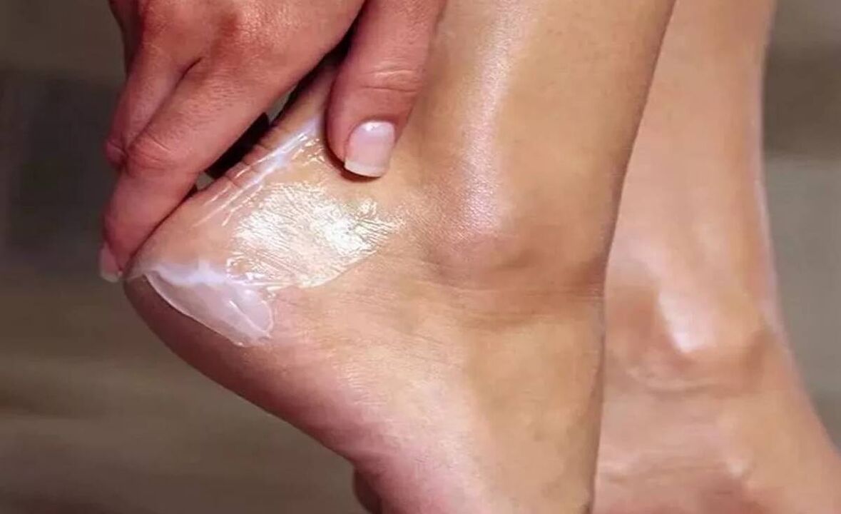 Kako liječiti gljivicu za podnožje sa šlagom zxcvbnmqwert