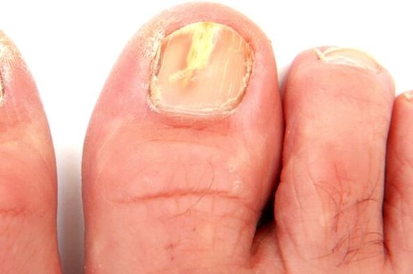 oštećenje ploče nokta zbog gljivične infekcije